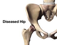 Diseased Hip