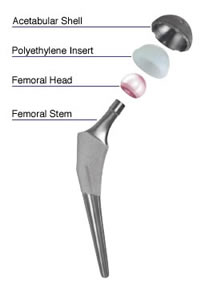 Hip Implants