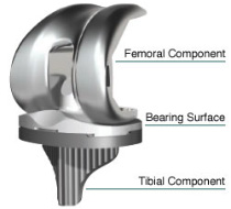 Knee Implants