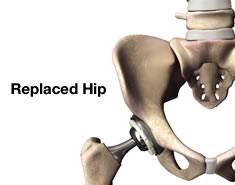 Replaced hip