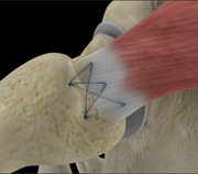 Abductor Tendon Repairs