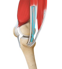 ACL Reconstruction Procedure – Hamstring Tendon