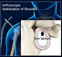 Arthroscopic Shoulder Stabilization-Labral Repair, BANKART Repair