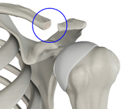 Distal Clavicle Excision/Resection