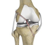 Knee Ligament Reconstruction