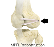 Medial Patello-femoral Ligament Reconstruction-Patellofemoral Re-alignment