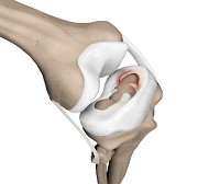 Meniscal Tears