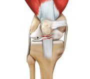 Patella Tendon Rupture