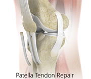 Patellar Tendon Repair