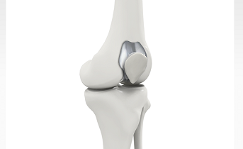 Patellofemoral Knee Replacement