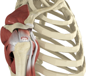 Rotator Cuff Tear