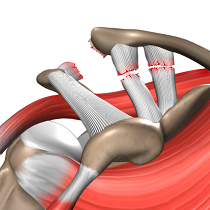 Shoulder Separation