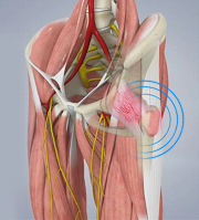 Snapping Hip Syndrome