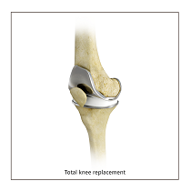 Total Knee Replacement